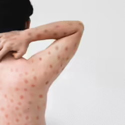 Illustration showing mpox virus structure as UK health authorities monitor cases of clade Ib mpox