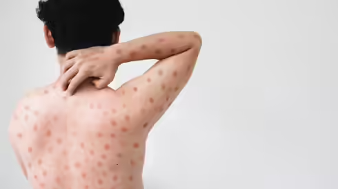 Illustration showing mpox virus structure as UK health authorities monitor cases of clade Ib mpox